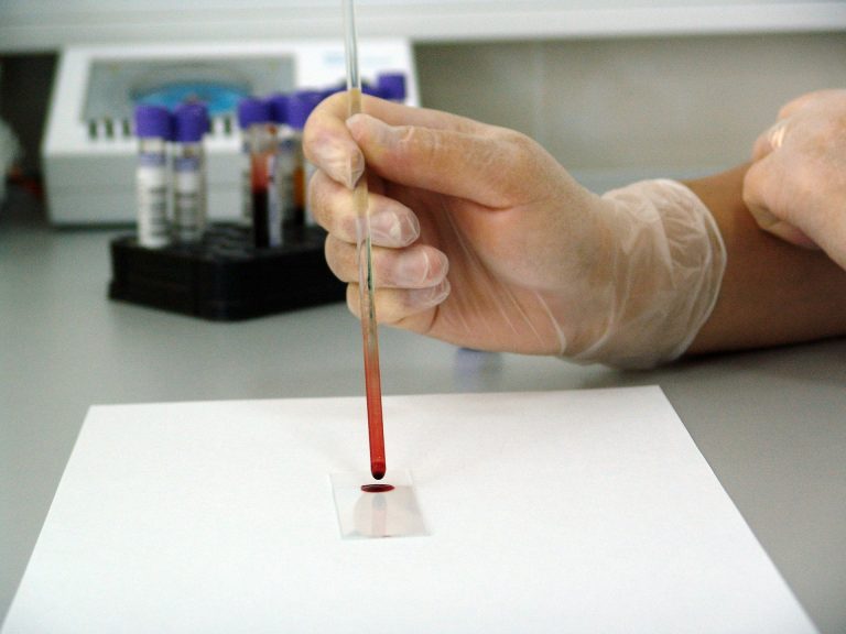 Prélèvement d'un échantillon sanguin lié à la sclérose en plaques.