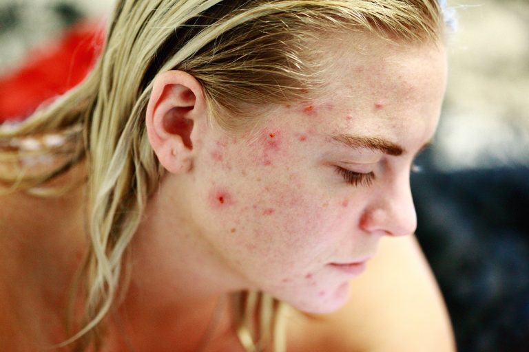 femme avec de l'acné