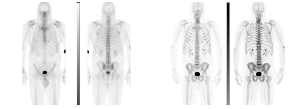 À gauche, les résultats d’une scintigraphie osseuse (ancien examen), à droite, les résultats d’une TEP au NaF (nouvel examen). (Photo gracieuseté)
